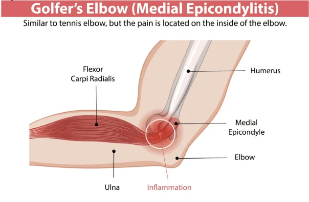 A graphic about Golfer's Elbow