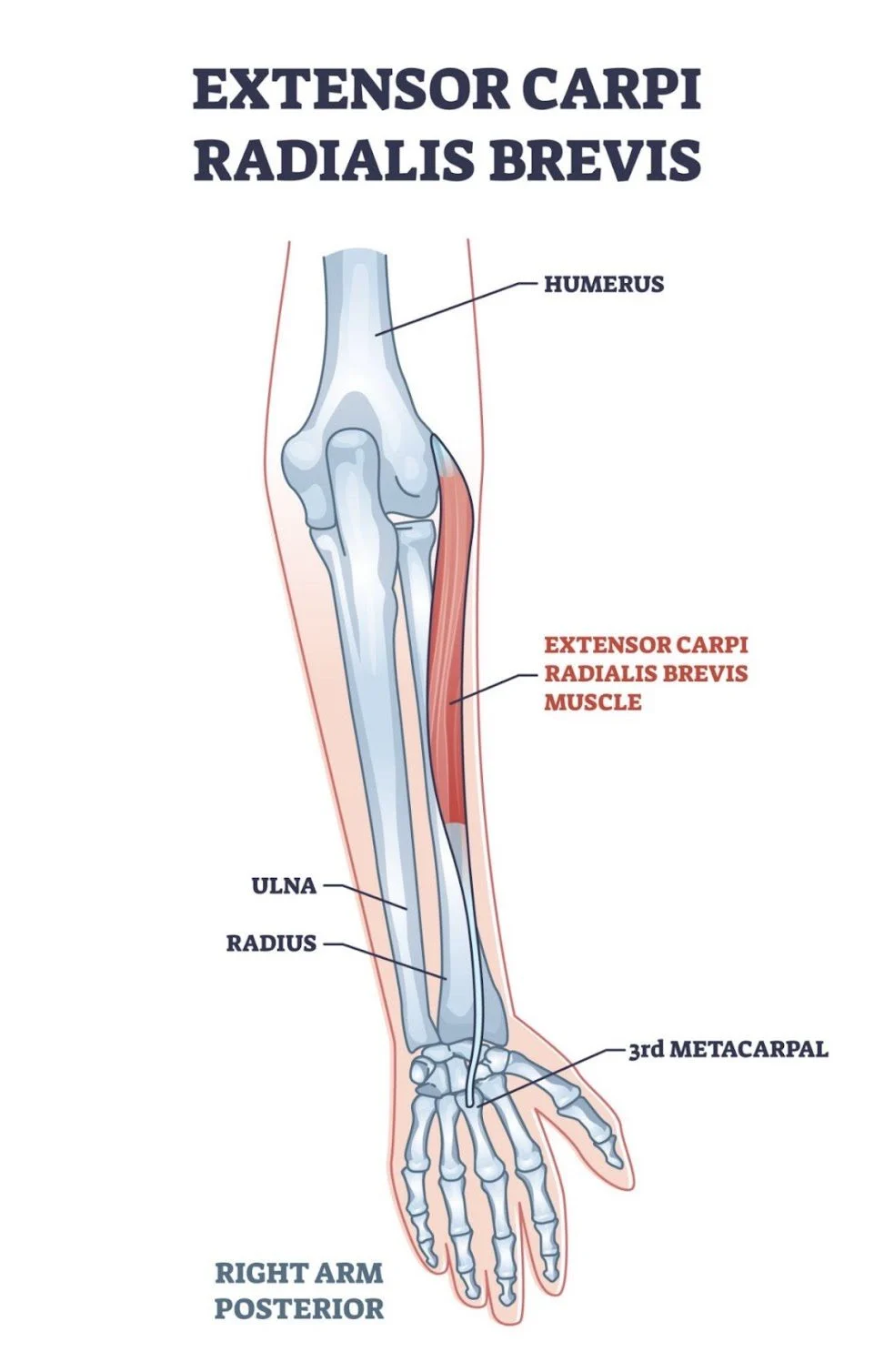 A graphic of the extensor carpi radialis brevis, used when playing tennis