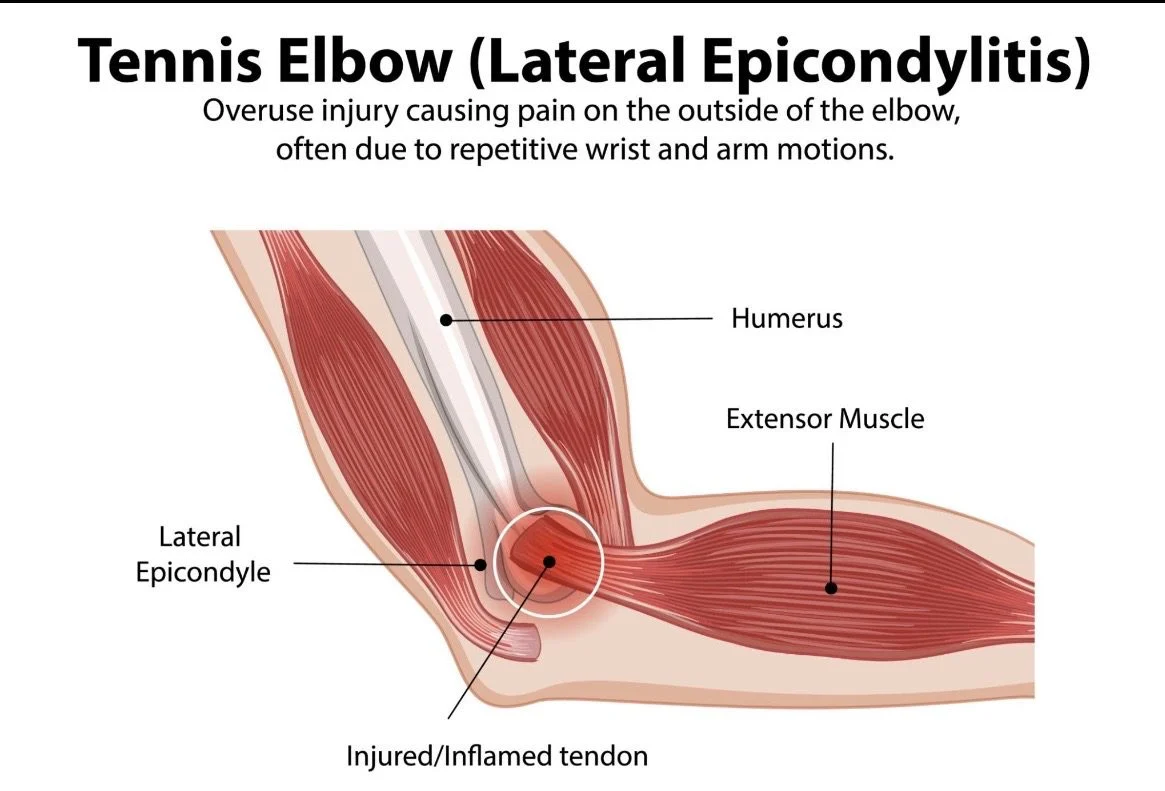 A graphic about Tennis Elbow