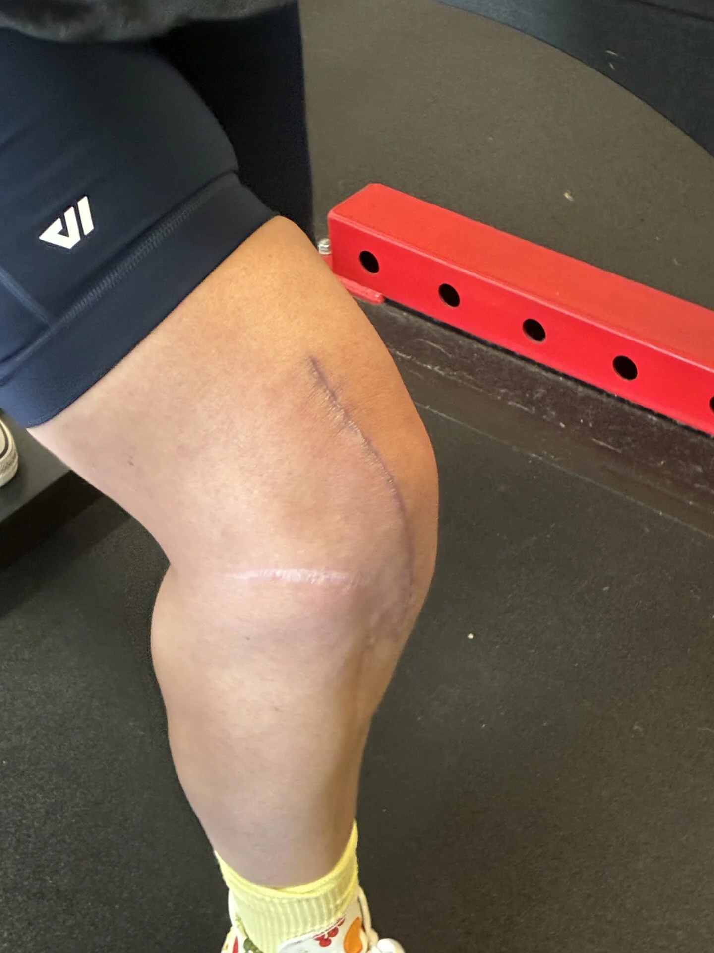 Close-up of knee reconstruction surgery scar during recovery